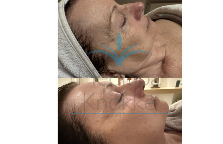 Peeling Seizoen 🥶: Environ-peeling tips