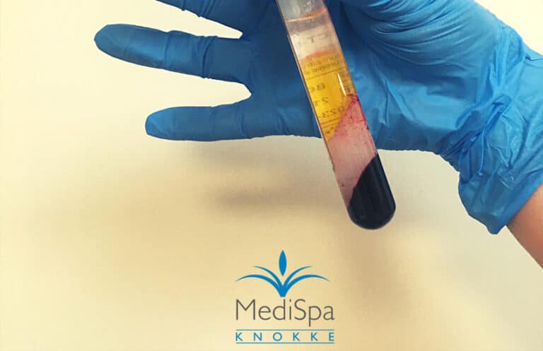 😃 🩸 PRP ”Vampire Facial” 🩸 😃